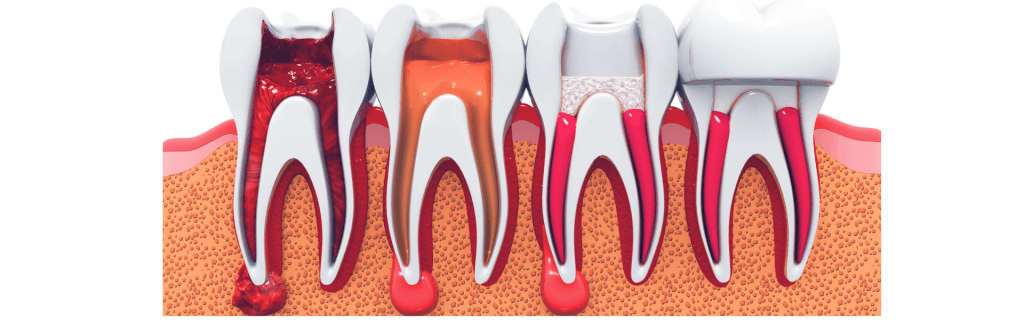 Root Canal Treatment, Procedure, Side effects and Guidelines